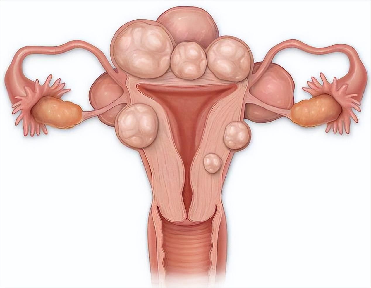 子宫腺肌症最新治疗方法